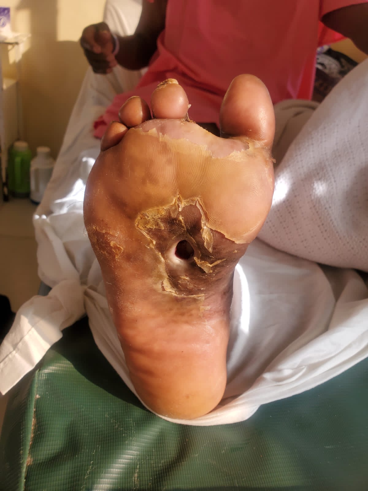 Diabetic Foot