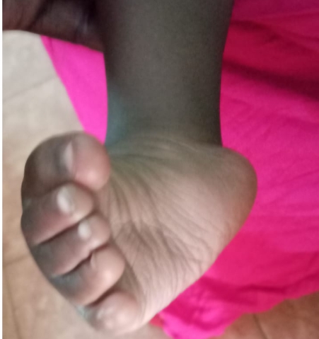 Treatment for flat foot