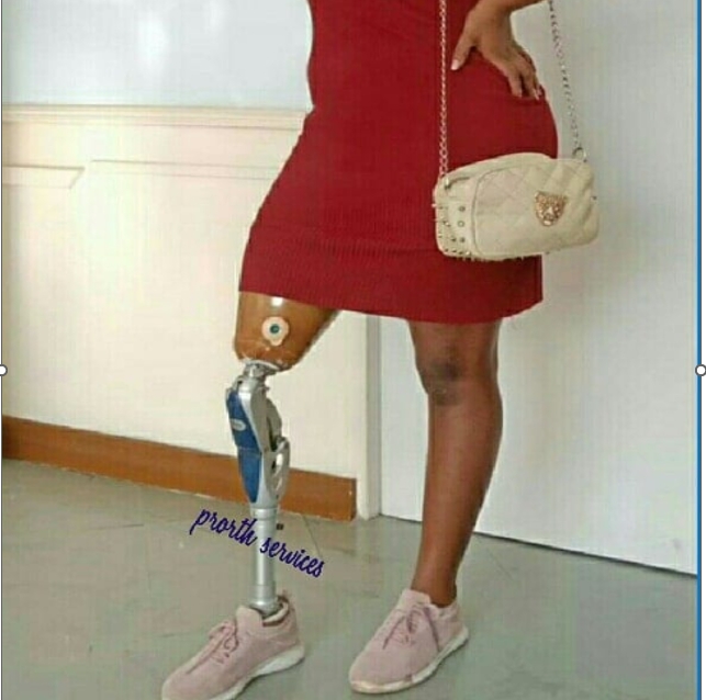 Patient with below-knee prosthesis